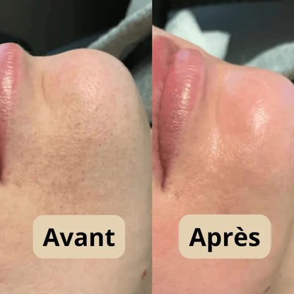 Peel Shot Coréen - Élimine les Impuretés et Sublime Votre Peau